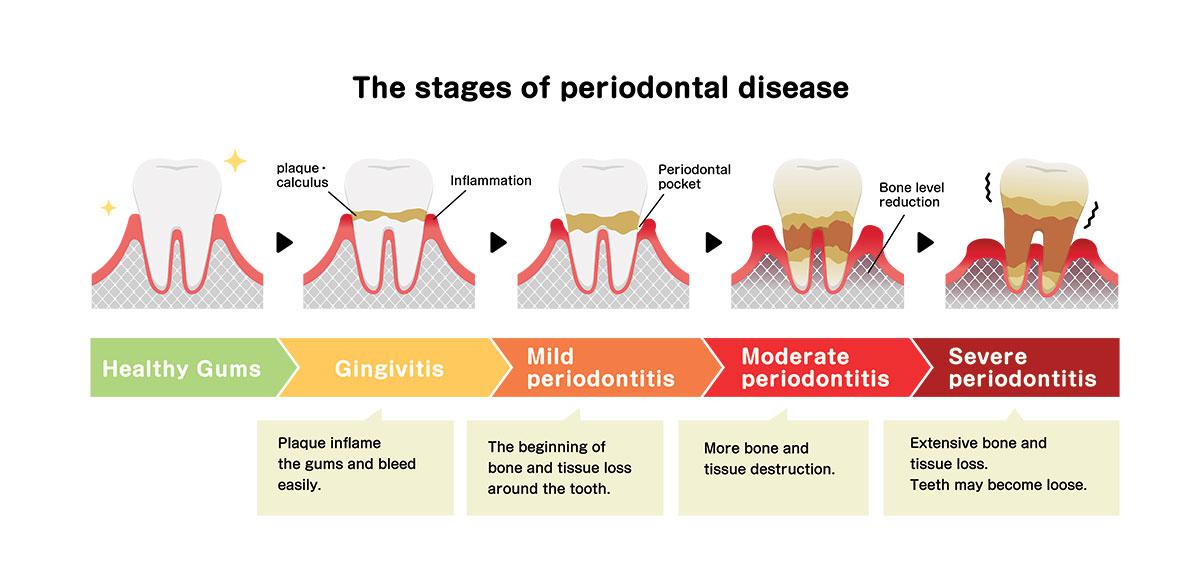 stages of gum disease and treatment in the City of Orange, CA